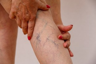 causes des varices
